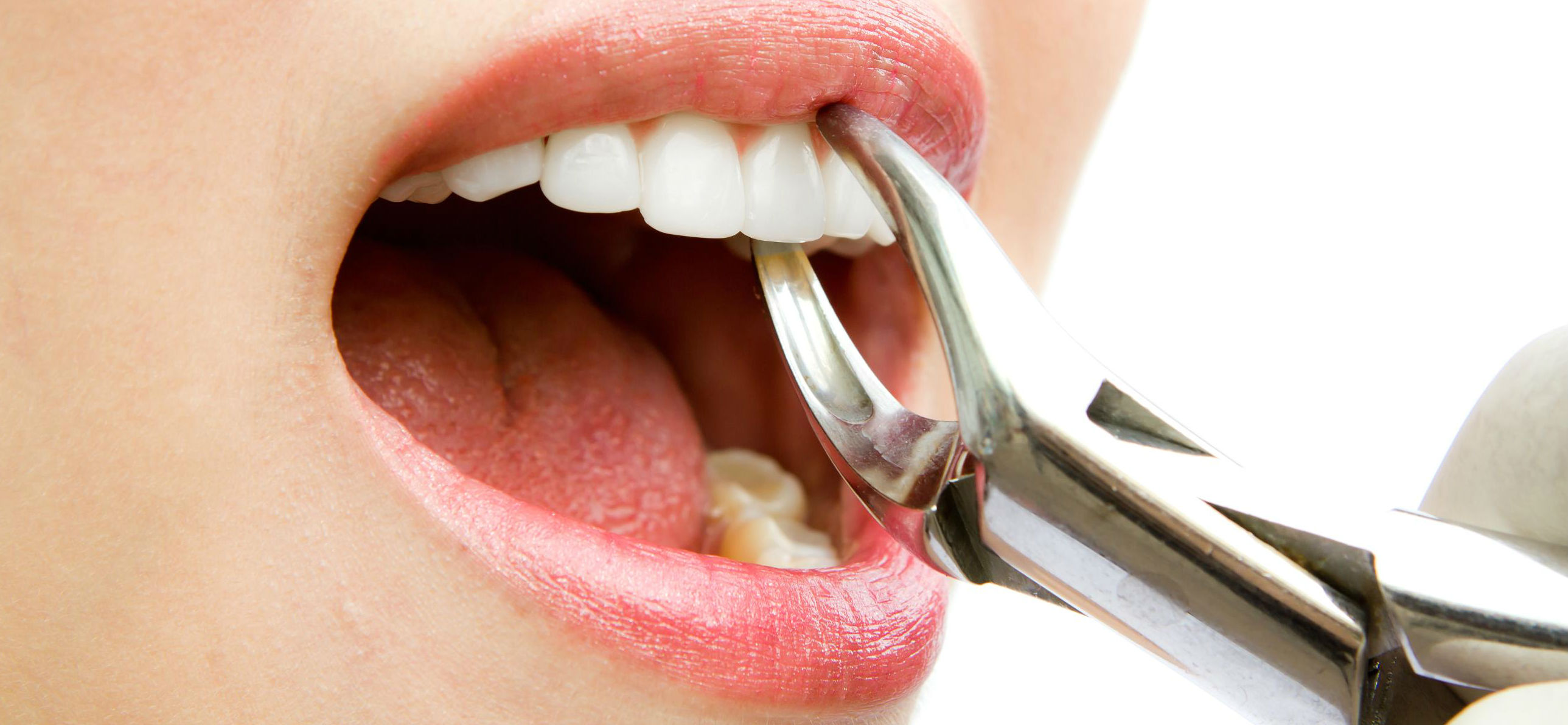 Oral Surgery Wisdom Tooth 22