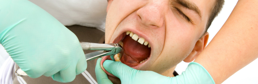 Management for Wisdom Tooth Removal