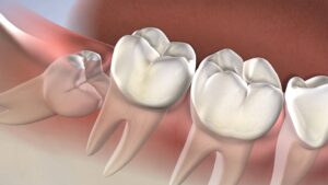 The Wisdom Teeth Removal in Sydney - The Procedure