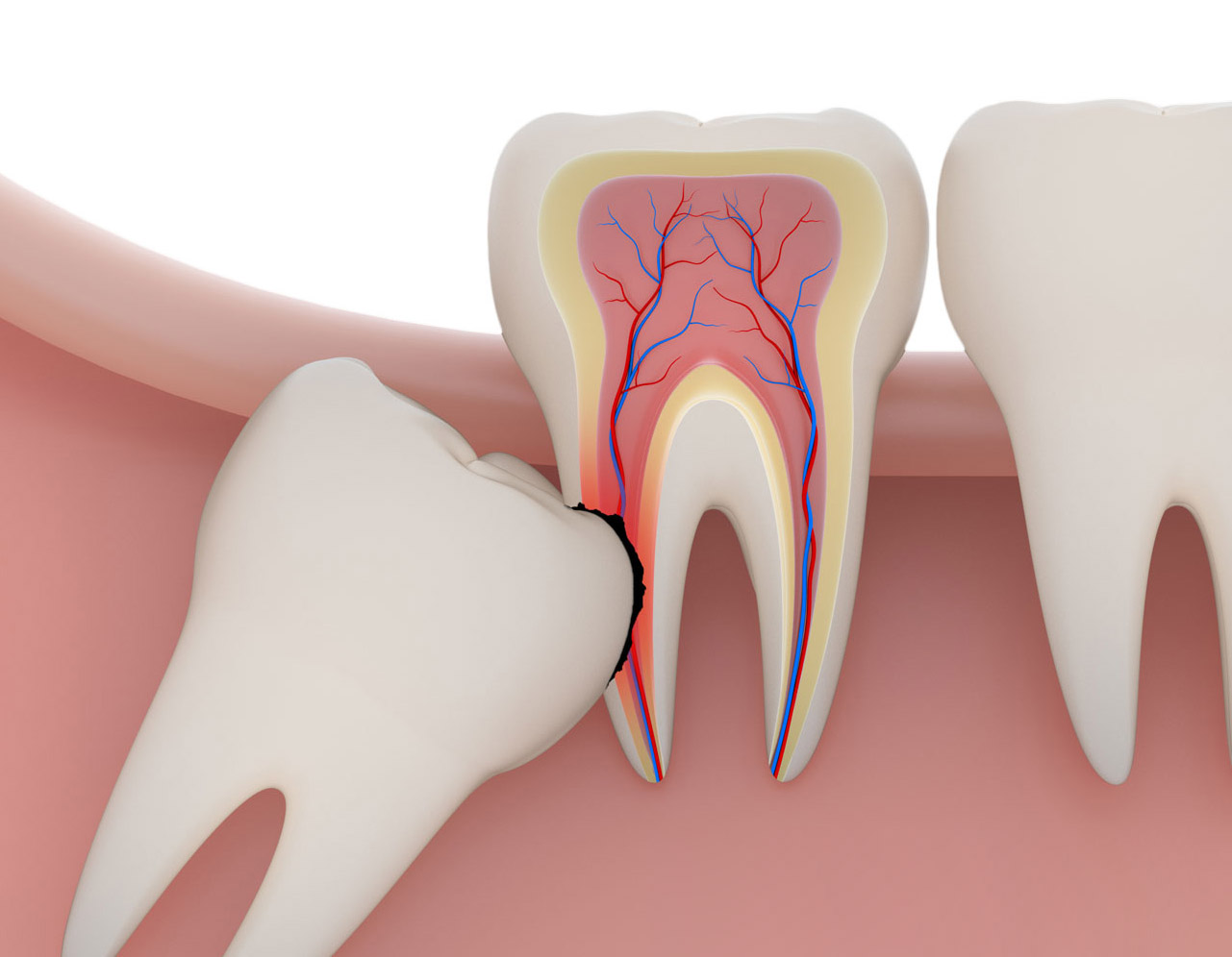 wisdom teeth removal cost - wisdom teeth removal sydney professionals - sydney