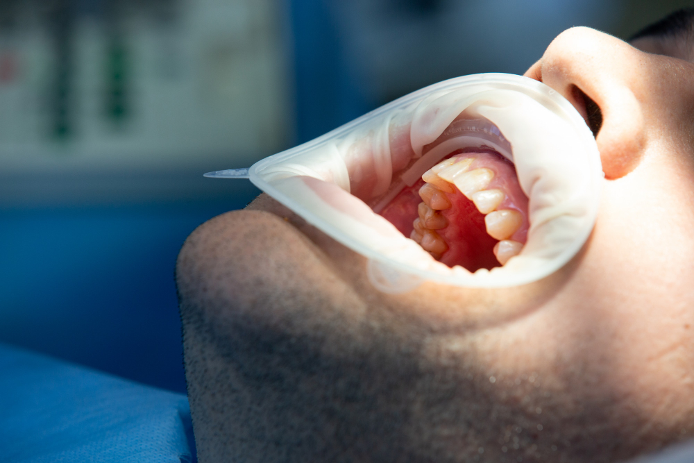 Expert Wisdom teeth removal services in Sydney