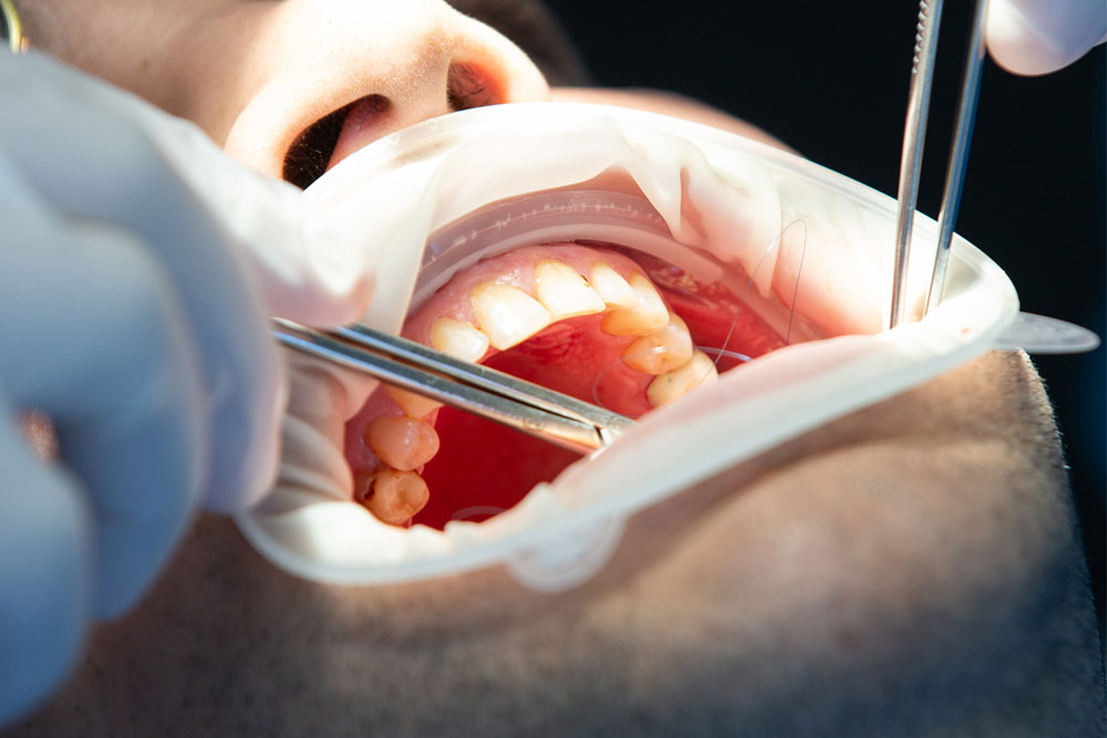 Wisdom teeth removal by an expert